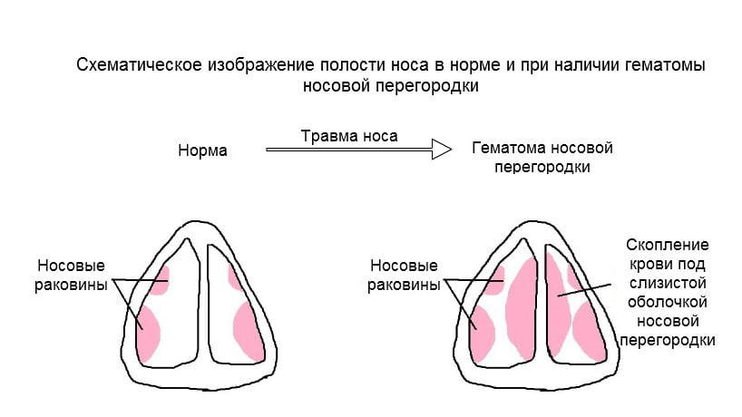 Схематическое изображение полости носа в норме и при наличии гематомы носовой перегородки