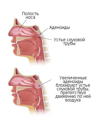 Увеличенные аденоиды блокируют устье слуховой трубы, препятствуя движению воздуха по ней